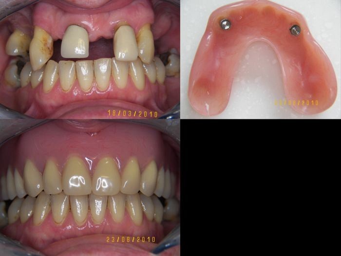 Young Dentures Before And After Portage MI 49024